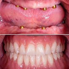 Implant-Retained Dentures-Naples FL | Advanced Prosthodontics & Implant  Esthetics